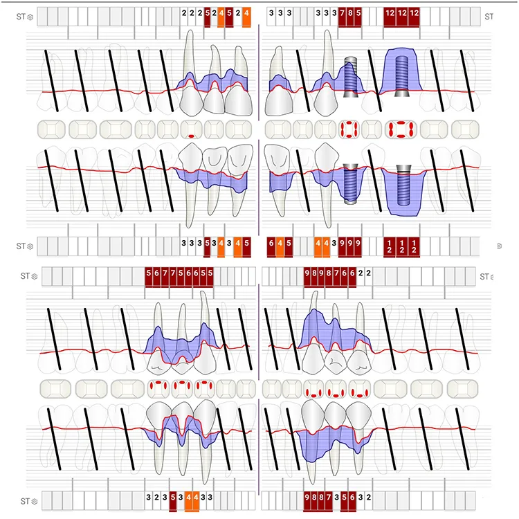 Abb. 10: Parodontaler Befund: An zahlreichen Zahnflächen konnten abstreifbare und mineralisierte Beläge sowie gingivale Blutungen detektiert werden. Es liegt eine generalisierte Parodontitis Stadium 4, Grad B vor. Das bedeutet, dass neben der parodontalen und periimplantären Therapie eine umfangreiche orale Rehabilitation indiziert ist. Vor dem Hintergrund des fortgeschrittenen Alters wurde in den letzten Jahren von invasiven zahnärztlichen Maßnahmen abgesehen. In Anbetracht der aktuellen klinischen Symptomatik, bei derzeit allerdings nicht vorhandenem Leidensdruck oder Schmerzen, besteht aber größerer Sanierungsbedarf. Das Implantat in regio 26 ist nicht zu erhalten. Inwiefern das verbleibende Implantat und die parodontal stark geschädigten Zähne durch eine konservative Therapie in parodontal/periimplantär gesunde Verhältnisse überführt werden können, ist derzeit noch schwer abschätzbar. Eine systematische parodontale Therapie wurde der Patientin erklärt und nahegelegt. Jegliche Behandlungen sollten vor dem Hintergrund allgemeinmedizinischer und patientenbezogener Parameter (Lebensqualität) kritisch gegeneinander abgewogen bzw. unter altersentsprechenden Kautelen durchgeführt werden.