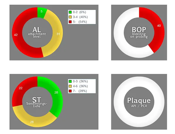 Abb. 11: Die Zusammenfassung der parodontalen Befunde mittels sogenannten Donut-Diagrammen unterstreicht die Ausdehnung der parodontalen Symptomatik (64% der Sondierungstiefen ≥ 4 mm). Der Plaque-Index lag bei 100%.
