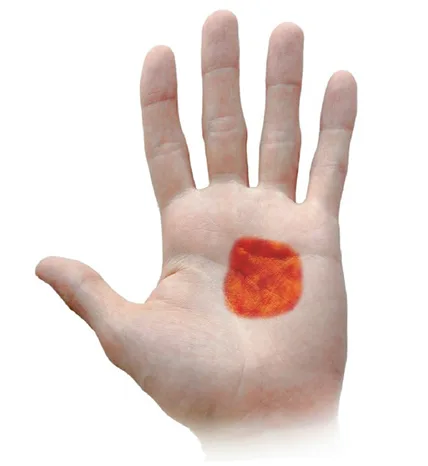 Abb. 12: Grafische Darstellung der entzündeten Wundfläche (PISA, periodontally inflamed surface area). Das befallene Areal wird hier verglichen mit der Ausdehnung einer durch schnittlichen Handinnenfläche und beträgt 1014,59 mm2.