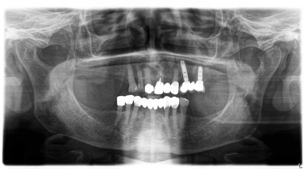 Abb. 8: Die Panoramaschichtaufnahme vom Untersuchungstag im März 2025 zeigt unter anderem fortgeschrittenen, generalisierten, horizontalen Knochenverlust mit einzelnen vertikalen Defekten sowie ausgeprägte periimplantäre Läsionen im linken Oberkieferseitenzahngebiet.