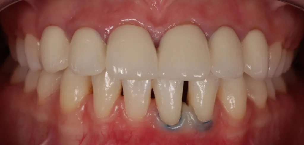 Abb. 1: Front in Okklusion.