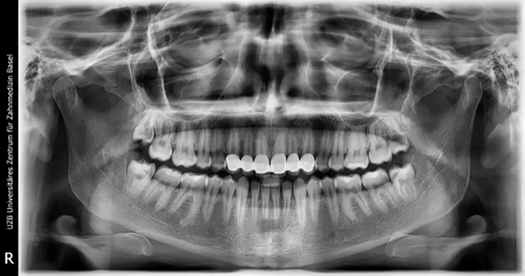 Abb. 1a: OPT Ausgangsituation.