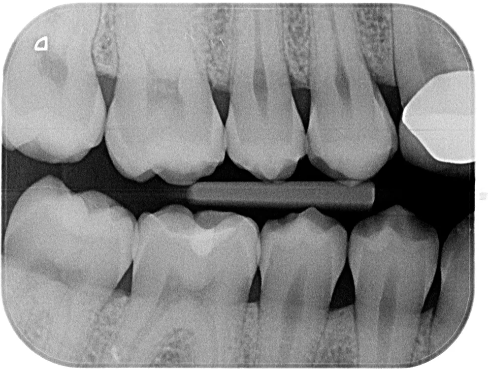 Abb. 1b: Bissflügelaufnahmen.