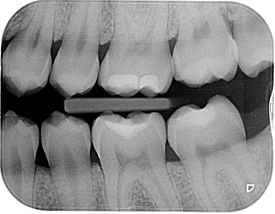 Abb. 1c: Bissflügelaufnahmen.