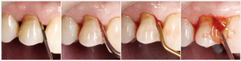 Abb. 1 a-d: Hyaluronsäureprodukte in Gelform können an Zähnen mit erhöhten Sondierungstiefen (a) nach einem nichtchirurgischen Debridement (b, c) in der zahnärztlichen Ordination supra- und subgingival appliziert werden (d).