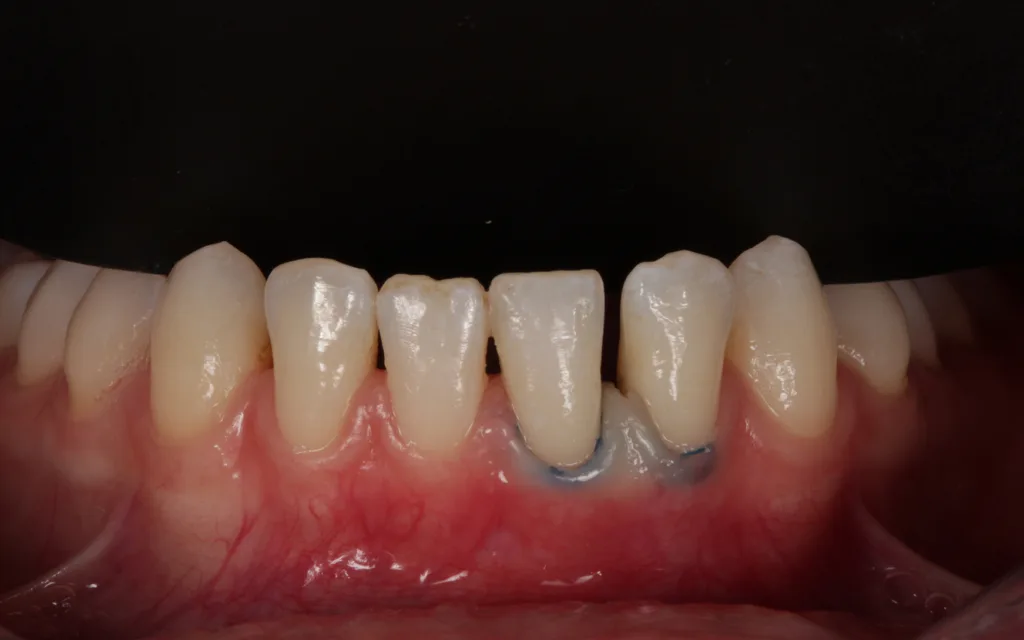 Abb. 2: UK-Front 33 bis 43 (bereits eingelegte Retraktionsfäden).