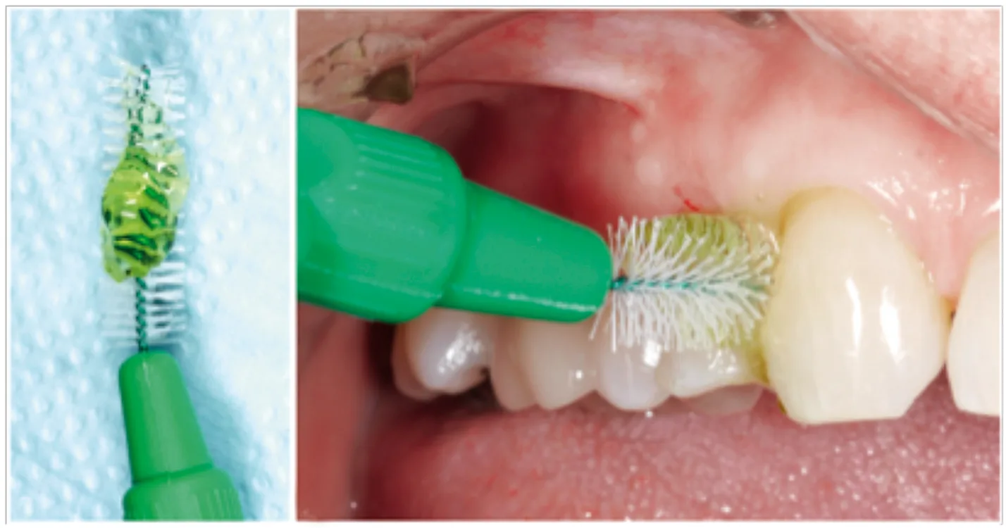 Hyaluronsäureprodukte in Gelform können durch die Patientinnen und Patienten täglich mittels Interdentalraumbürsten appliziert werden.