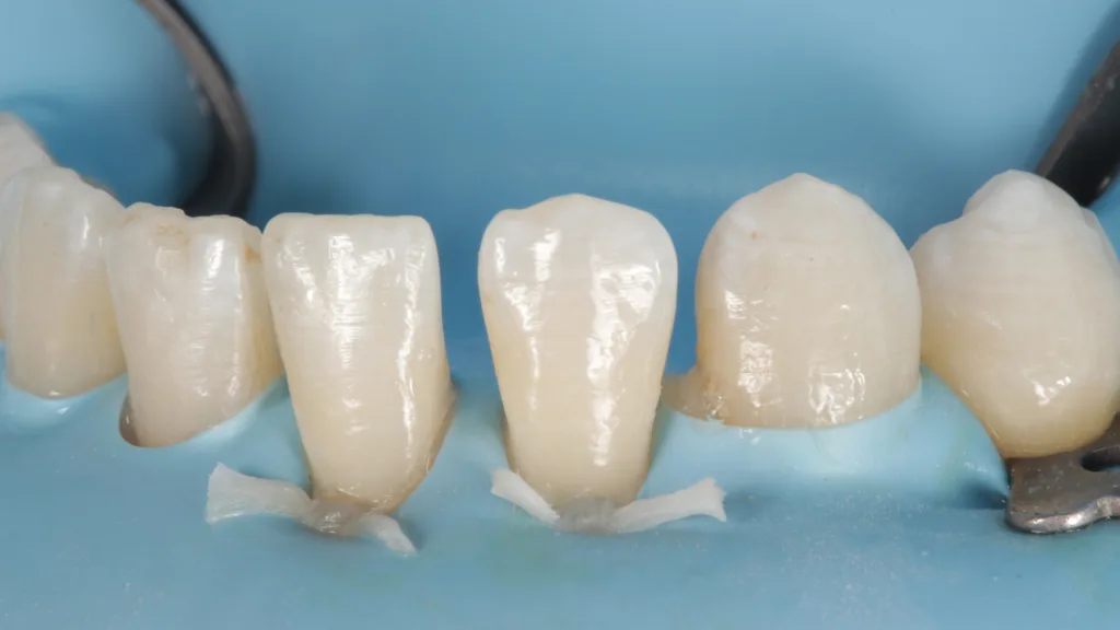 Abb. 3: Absolute Trockenlegung mit Kofferdam und Ligaturen.