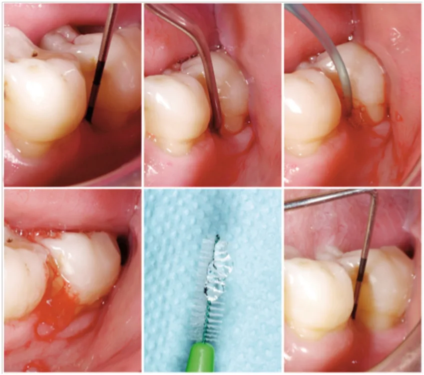 Abb. 3 a-e: Die Patientin präsentierte sich in der unterstützenden Parodontaltherapie (Stufe 4) mit einem Rezidiv an Zahn 47 – 5 mm Sondierungstiefe und Blutung nach Sondieren (a). Nach einem erneuten Debridement (b, c) kann das Hyaluronsäureprodukt sowohl in der Praxis (d) als auch zuhause durch die Patientin (e) appliziert werden. Drei Monate später bei der nächsten unterstützenden Parodontaltherapie zeigte sich eine entzündungsfreie Situation – 4 mm Sondierungstiefe ohne Blutung nach Sondieren.