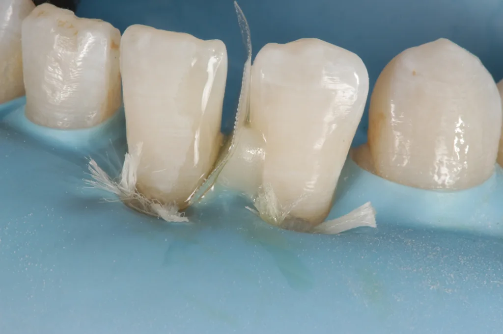 Abb. 4: Abstrahlen der Schmelzoberfläche (minimalinvasiv, Non-Prep) mit Aluminiumoxidpulver der Korngröße 27 μm, Anlegen einer gewölbten Matrize und Fixierung mit Flowable Komposit (Tetric Flow, Ivoclar), Schmelzätzung mit 37%iger Phosphorsäure (Ultradent).