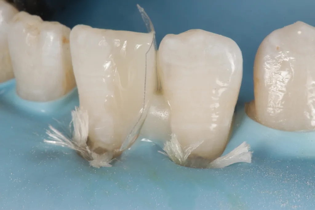 Abb. 5: Schichtung mit Komposit (Empress Direct Enamel A1, Ivoclar).