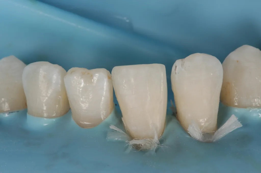 Abb. 6: Fertig geschichtete Restauration an 31, Ausarbeitung, Politur.