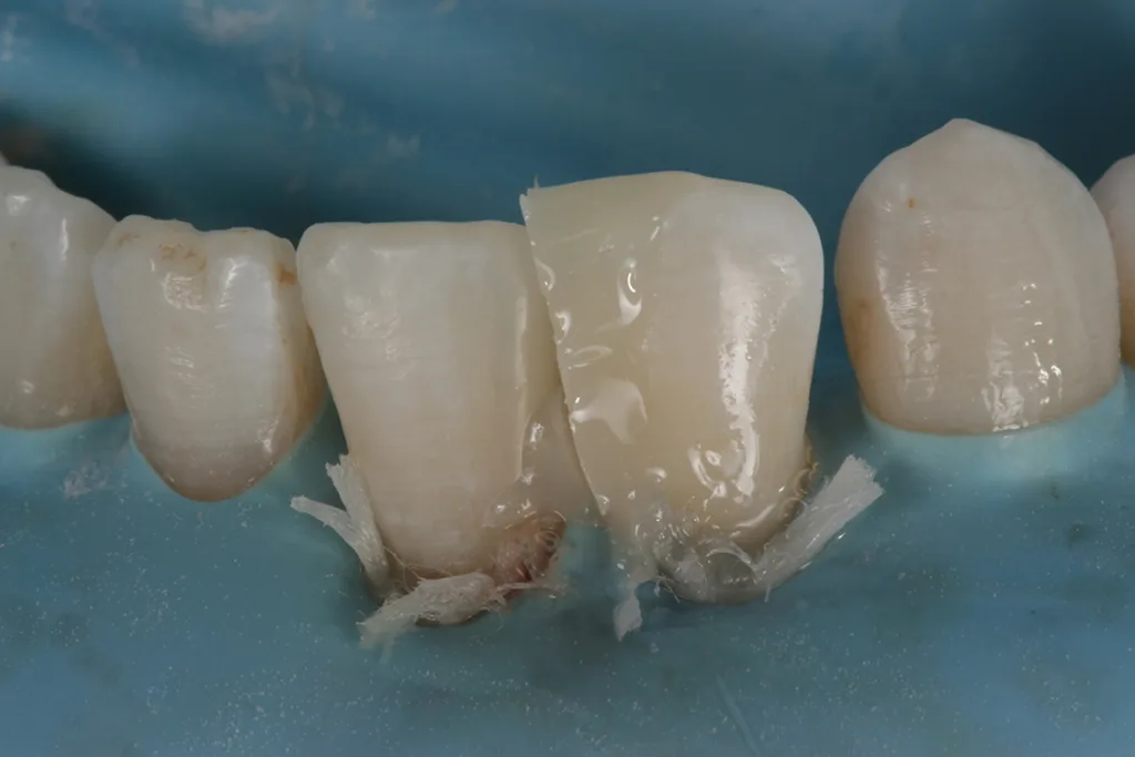Abb. 7: Schichtung mit Komposit an 32 (Empress Direct Enamel A1, Ivoclar).
