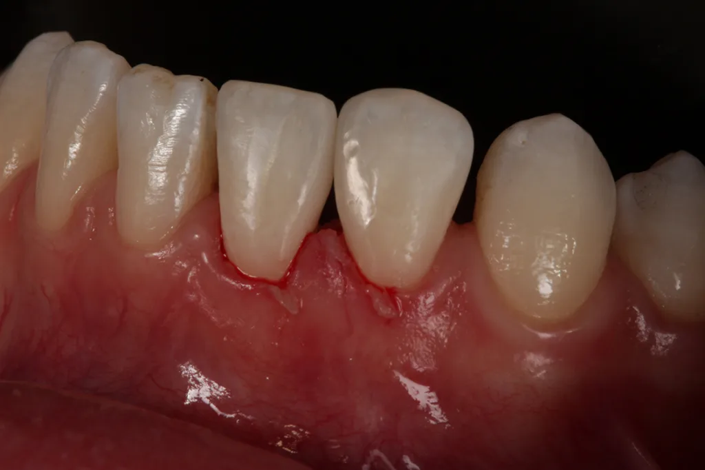 Abb. 9: Fertiggestellte Kompositrestaurationen 31 und 32.