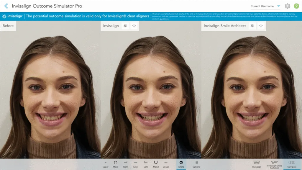 In Verbindung mit dem Invisalign Outcome Simulator Pro gewinnt das Video noch mehr Wirkung.