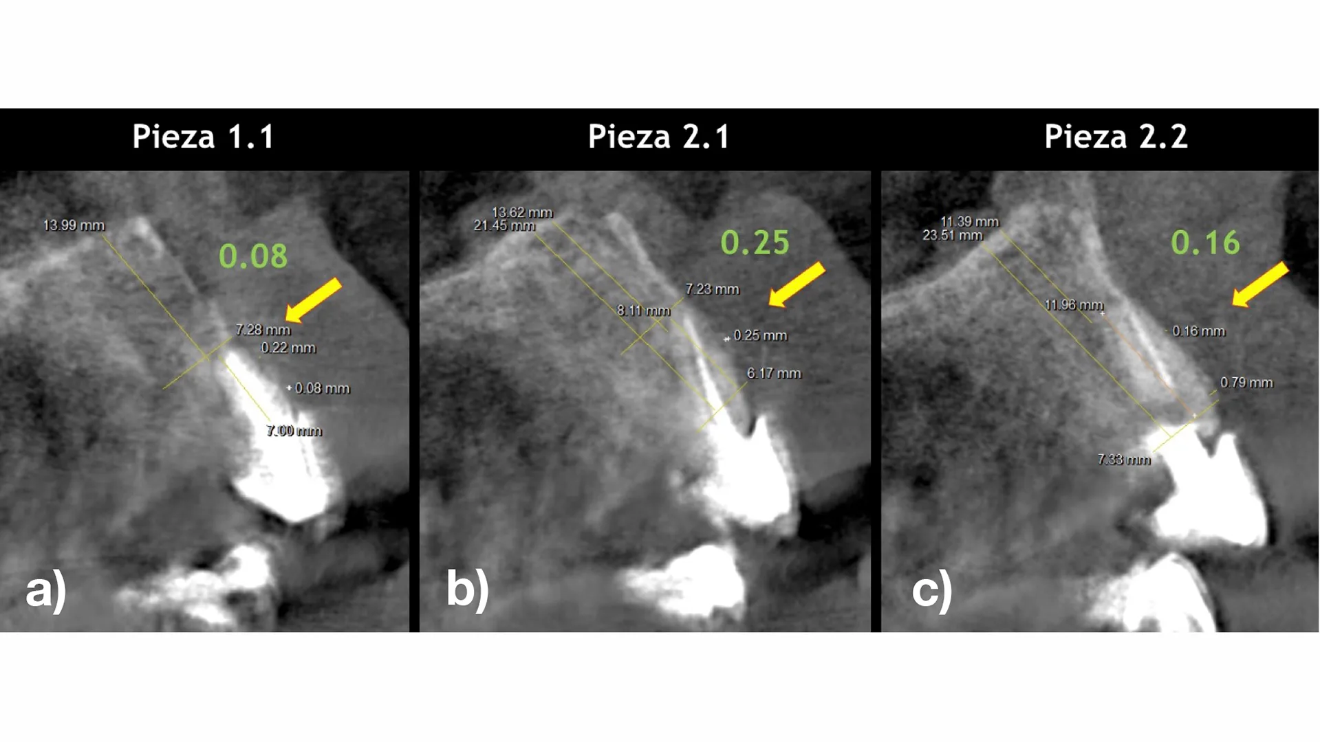 Sagittale tomografische Schnitte der Zähne 1.1, 2.1 und 2.2 mit Darstellung der sehr dünnen vestibulären Knochenlamellen von weniger als 0,2 mm Dicke (a, c).