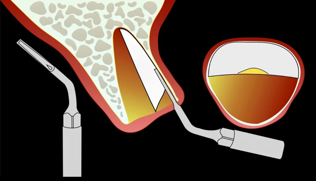 Abbildung 10: Präparation“ des vestibulären Wurzelfragments mit dem piezoelektrischen Instrument (EX1, W&H) zur Periostablösung. Zeigt die Tomographie eine sehr dünne Knochenlamelle, sollte auf eine Instrumentierung direkt an dieser Seite verzichtet werden. Stattdessen erfolgt der Zugang über die inneren Ränder der benachbarten Wurzel.
