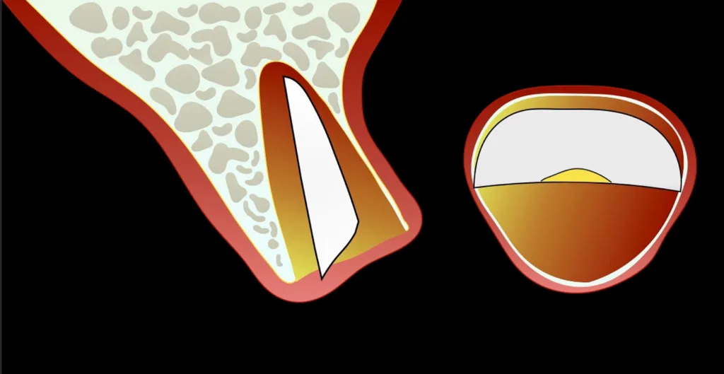 Abbildung 11: Verlagerung des vestibulären Fragments in den palatinalen Raum der Alveole.