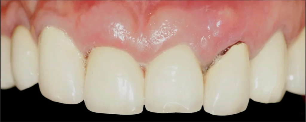 Abbildung 13: Frontale Ansicht der Zähne 1.1, 2.1 und 2.2 mit Wurzelfraktur. Sichtbar sind gingivale Konturunregelmäßigkeiten, sowie eine ausreichende Menge an keratinisierter Gingiva.