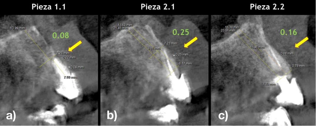 Abbildung 15: Sagittale tomografische Schnitte der Zähne 1.1, 2.1 und 2.2 mit sehr dünnen vestibulären Knochenlamellen von weniger als 0,2 mm Dicke (a, c).