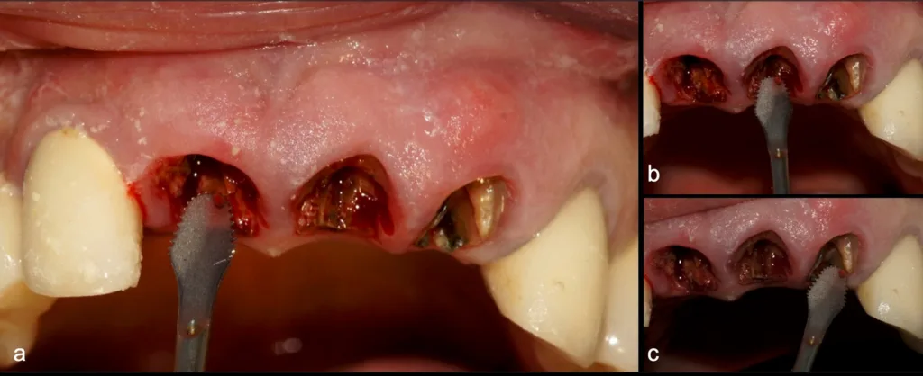 Abbildung 16: Initiale radikuläre Hemisektion in mesiodistaler Richtung (Tiefe ca. 10 mm) an den Zähnen 1.1, 2.1 und 2.2 unter Verwendung eines flachen, gezahnten Piezo-Instruments (B6, W&H), wobei auf den Schutz der proximalen Knochenlamellen geachtet wird (a, b, c).