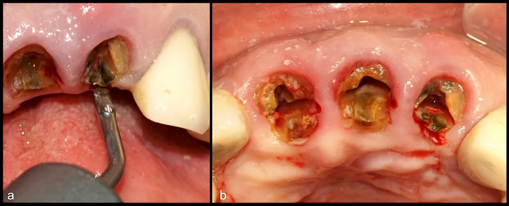 Abbildung 18: Syndesmotomie unter Verwendung des piezoelektrischen Instruments (EX1, W&H) (a), Positionierung am Desmodont der palatinalen Wurzelfragmente (b).