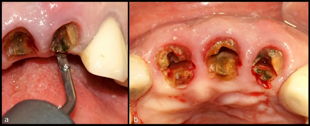 Syndesmotomie unter Verwendung des piezoelektrischen Instruments (EX1, W&H) (a), Positionierung am Desmodont der palatinalen Wurzelfragmente (b).