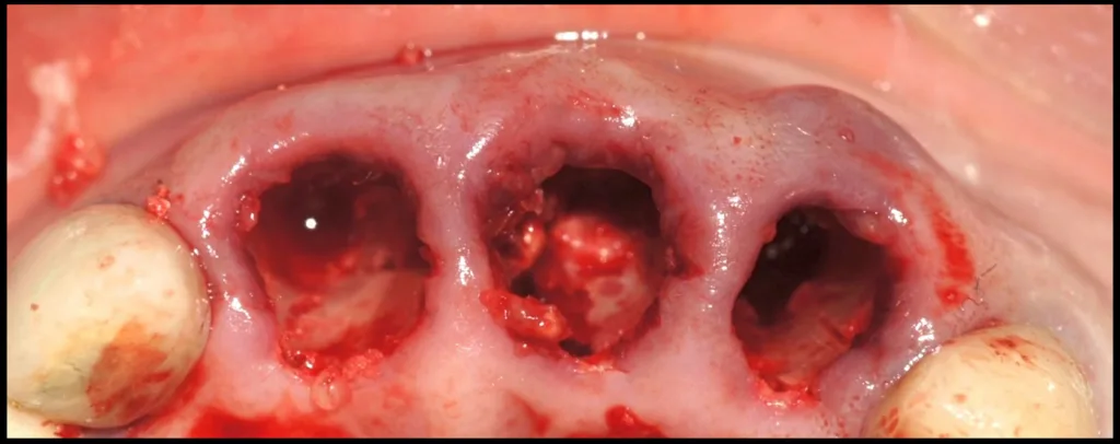 Abbildung 21. Postextraktive Alveolen der Zähne 1.1, 2.1 und 2.2.