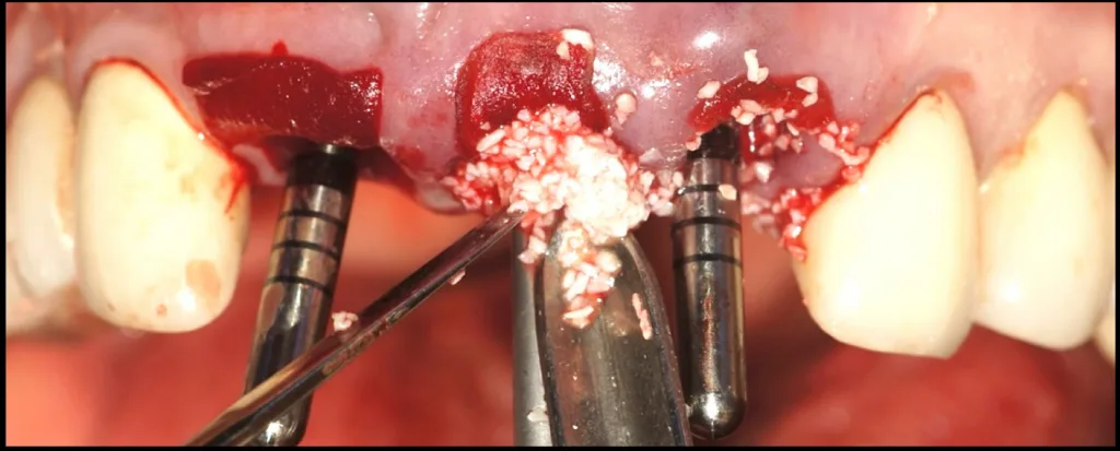 Abbildung 23: Einbringen von bovinem Knochenersatzmaterial zwischen Ausrichtungsstiften und Membran. Dabei ist zu berücksichtigen, dass mit zunehmendem verbleibendem Raum auch die Dicke der neuen vestibulären Knochenplatte größer wird.