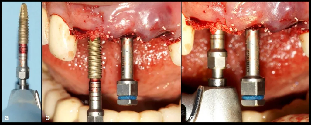Abbildung 24: Okklusale Ansicht der mit Biomaterial versorgten Alveolen.