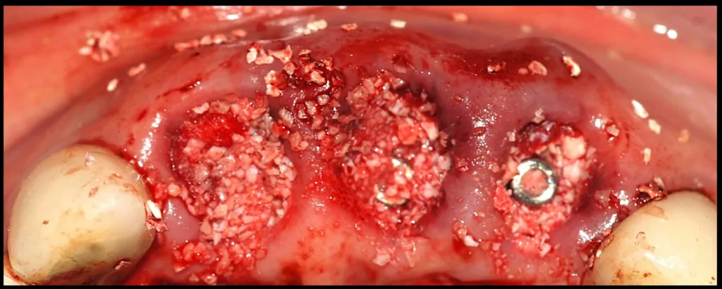 Abbildung 26: Okklusale Ansicht der Implantate und Kompaktierung des Knochenersatzmaterials.