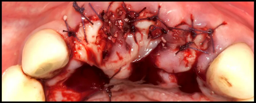 Abbildung 27: Wundverschluss mittels palatinal pedikuliertem, vestibulär rotiertem Lappen und Naht mit 4/0 Polyglykolsäurefaden; der freiliegende Bereich wird offen (sekundär) verheilt, wobei die Integrität der gingivalen Papillen möglichst erhalten bleibt.