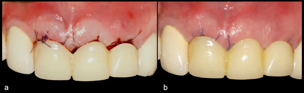 Abbildung 28: Postoperative frontale Ansicht mit herausnehmbarer provisorischer Prothese (a). Kontrolle am siebten Tag mit zufriedenstellendem Heilungsverlauf und Erhalt der Papillenkonturen (b).