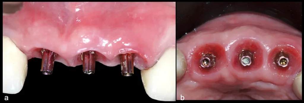 Abbildung 29: Universelle Abutments, nach 4 Monaten (a). Sichtbar ist zudem der Erhalt der Papillenhöhe. Okklusale Ansicht mit gesundem periimplantärem Gewebe, adäquater Ausbildung der Emergenzprofile und Erhalt der Alveolarkammkontur (b).