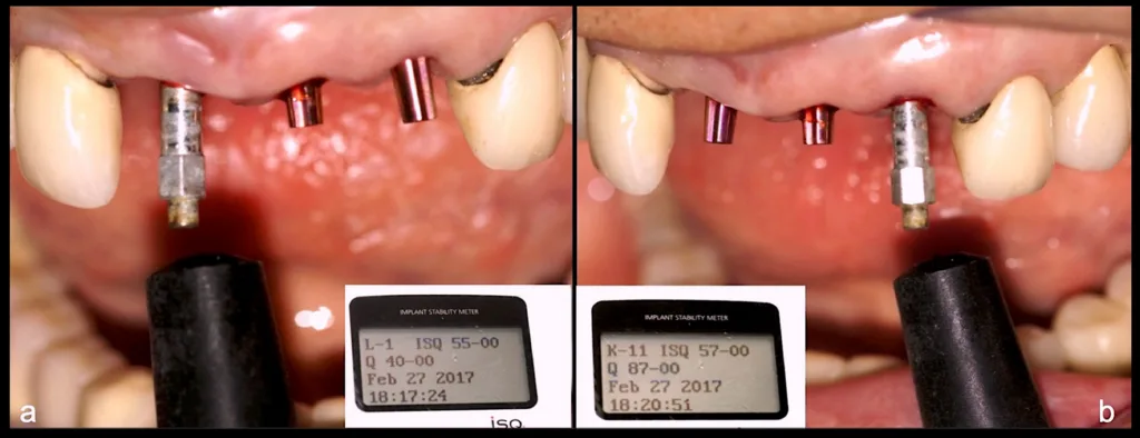 Abbildung 30: Kontrolle der Implantatstabilität mittels Resonanzfrequenzanalyse. Die ISQ-Werte liegen zwischen 55 und 57, was darauf hinweist, dass eine weitere Mineralisierung der periimplantären Knochenmatrix abzuwarten ist (a, b).