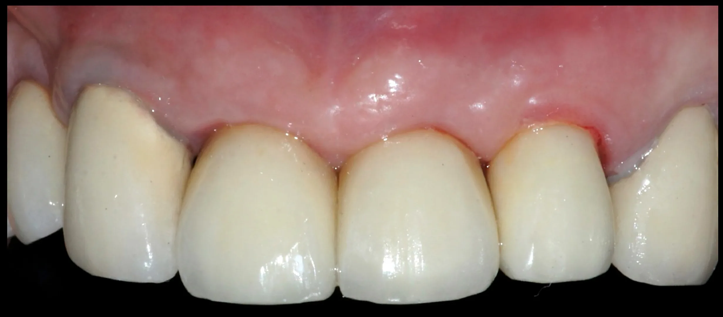 Abgeschlossener Fall unter Erhalt der Kontur des Alveolarkamms, der gingivalen Kontur und der Papillenhöhe.