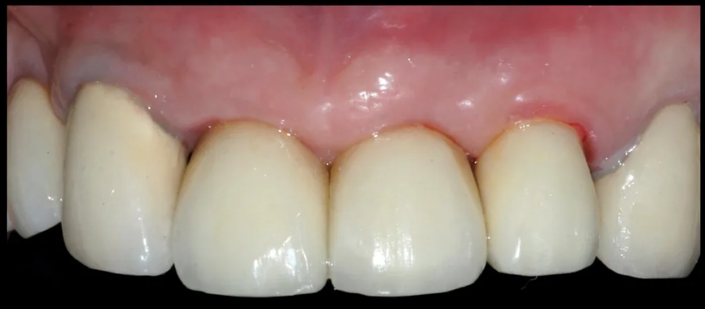 Abbildung 31: Abgeschlossener Fall unter Erhalt der Kontur des Alveolarkamms, der gingivalen Kontur und der Papillenhöhe.