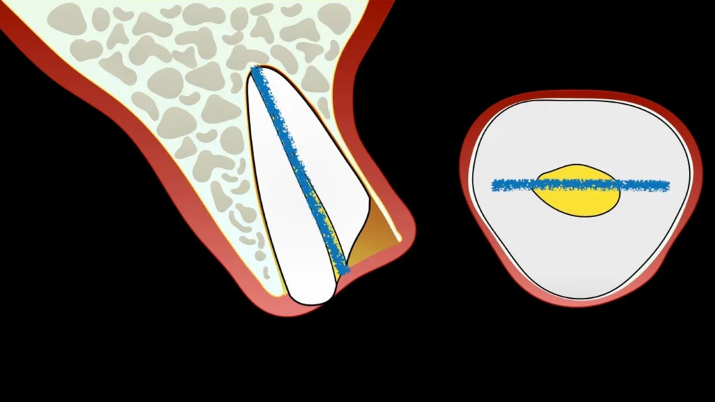 Abbildung 3: Mesio-distales Odontosektionsdesign mit langstieligem Schneideinstrument oder Bohrer.