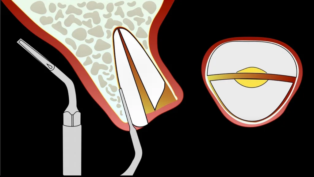 Abbildung 7: Präparation des palatinalen Wurzelfragments mit dem piezoelektrischen Periostlifter (EX1, W&H). Dieses Fragment wird aufgrund der in der Regel größeren Dicke der palatinalen Knochenlamelle gewählt.