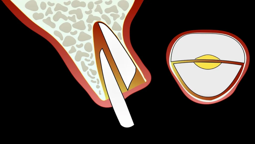 Abbildung 9: Entfernung (Avulsion) des palatinalen Fragments.