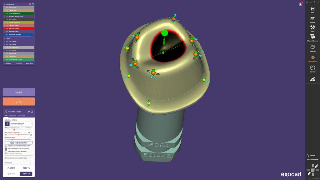 Neue Funktionen beim Abutment-Design