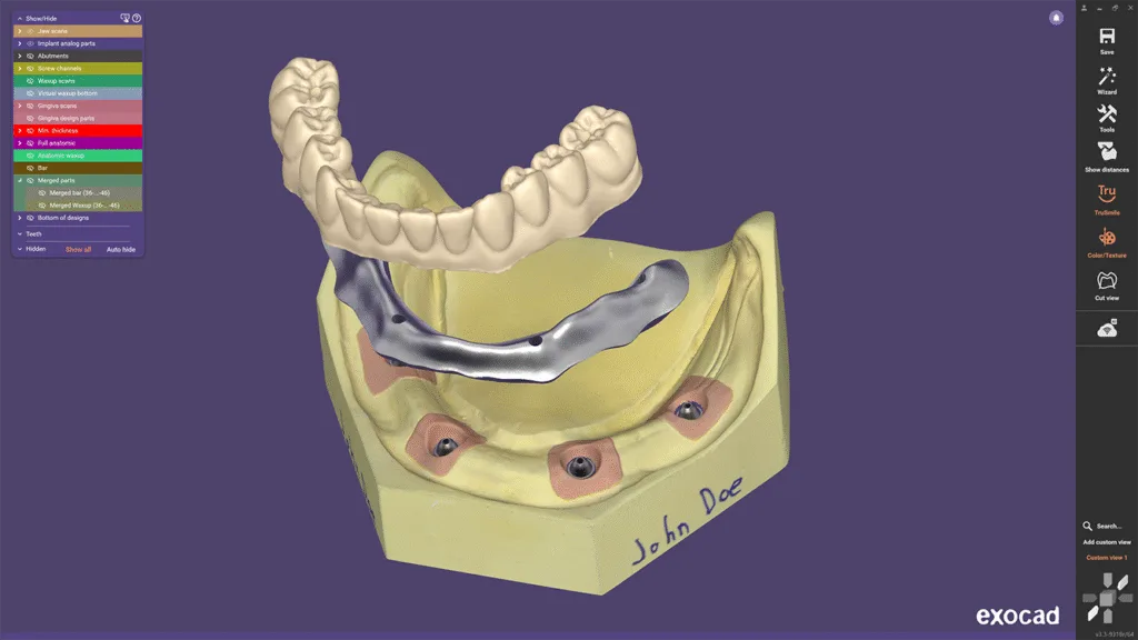 Neuer Designworkflow für Split-Prothesen