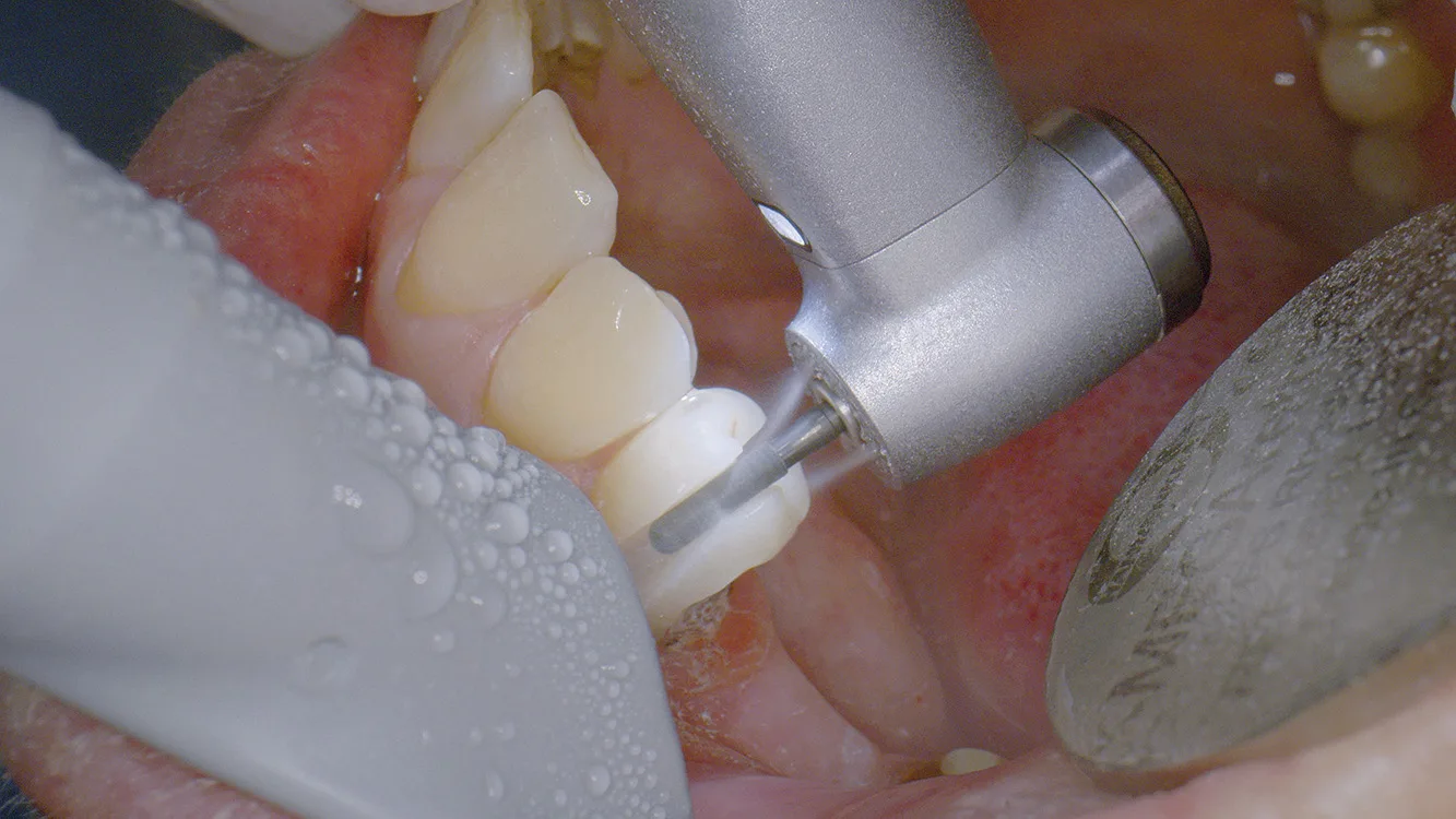 Synea Power Edition – die ideale Lösung zur Entfernung von Kronen oder Brücken.