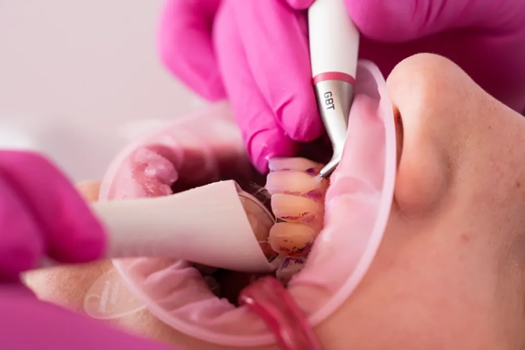 bb. 4: Mit AIR-FLOWING® lässt sich der angefärbte Biofilm vollständig, patientenfreundlich und gewebeschonend entfernen, bei zugleich guter Wirtschaftlichkeit. Dies gelingt mit dem abgebildeten Handstück (AIRFLOW® MAX) supra- und bis zu 4 mm subgingival, für parodontale Taschen steht ein Handstück mit speziellen subgingivalen Aufsätzen (Nozzle) zur Verfügung (PERIOFLOW® MAX, GBT Schritt 5).