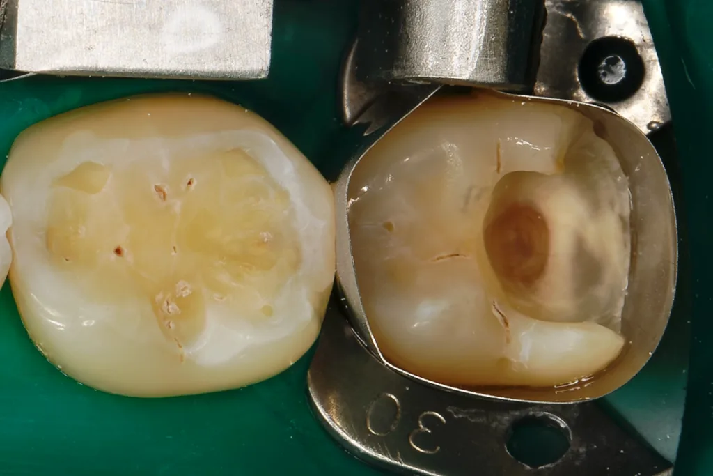 Exkavierte, mit Kofferdam isolierte Kavitäten an den Zähnen 37 und 36.