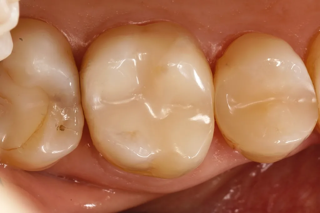 Unauffälliges ästhetisches Erscheinungsbild der Kompositneuversorgung.