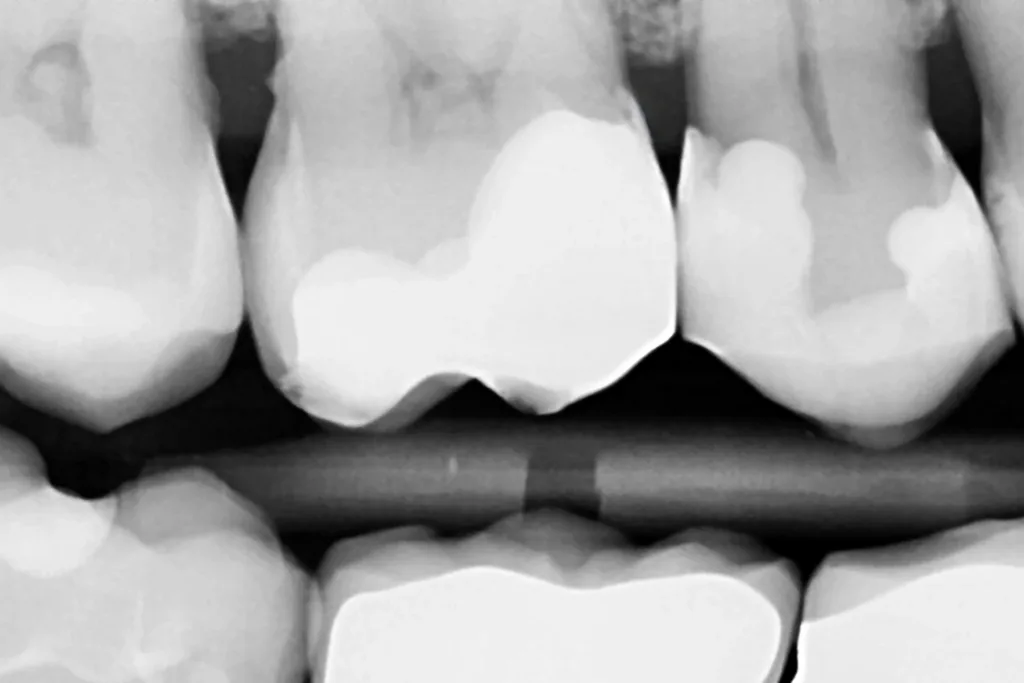 Bissflügel-Röntgenkontrollaufnahme.