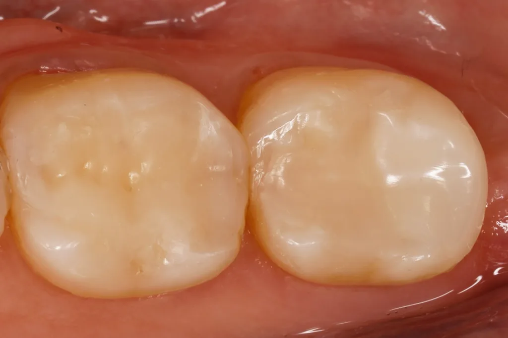 Ausgearbeitete und polierte Kompositversorgung der Zähne 37 und 36