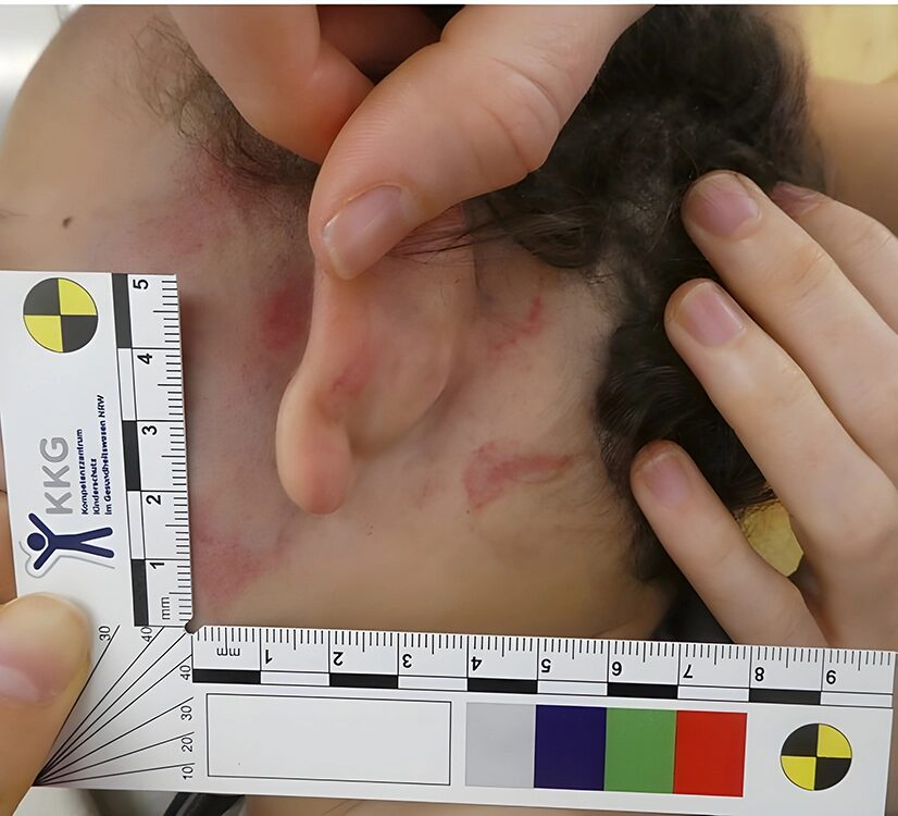 Retroaurikuläres Hämatom.