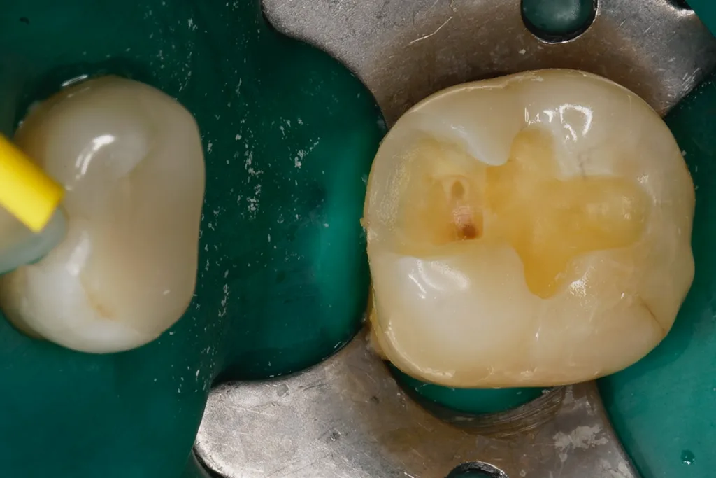 Klinische Situation nach Entfernung einer insuffizienten Kompositversorgung und Nachpräparation.